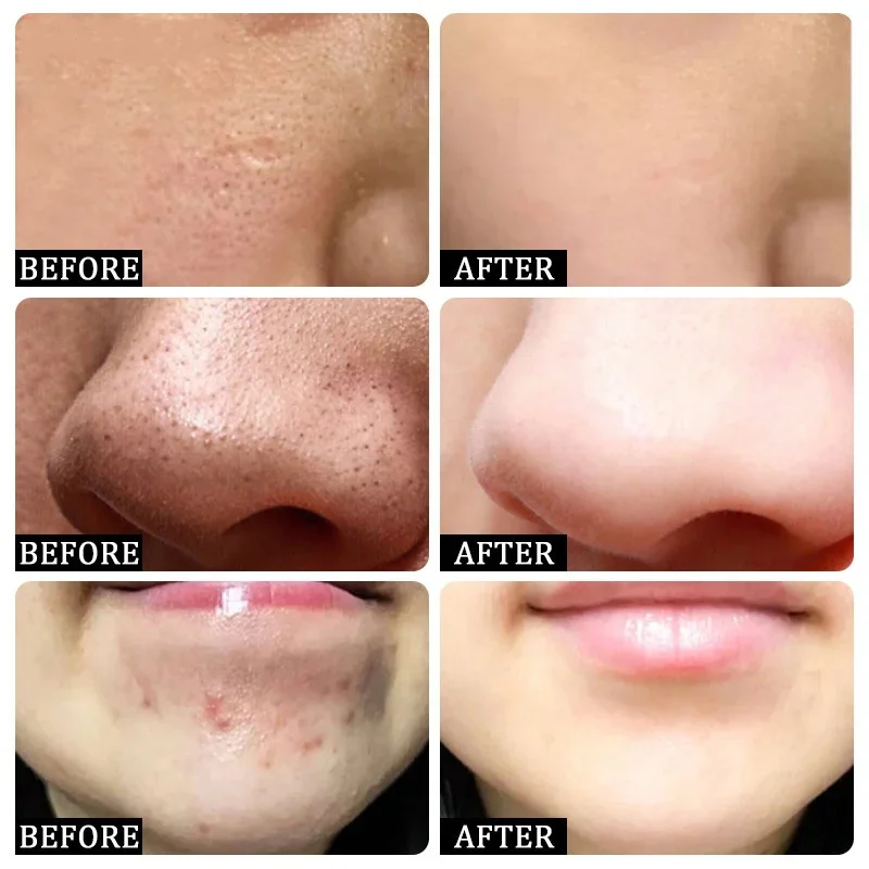 サリチル酸毛穴クリアリングクリーム毛穴を縮小黒ずみ除去にきび - Korean Skincare Routine のレビューと価格